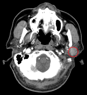 耳下腺癌の造影CT所見